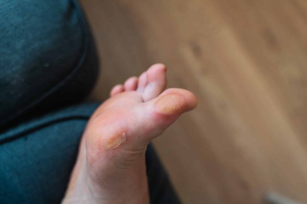 Quelle est la raison de la formation de corne sous les pieds ?